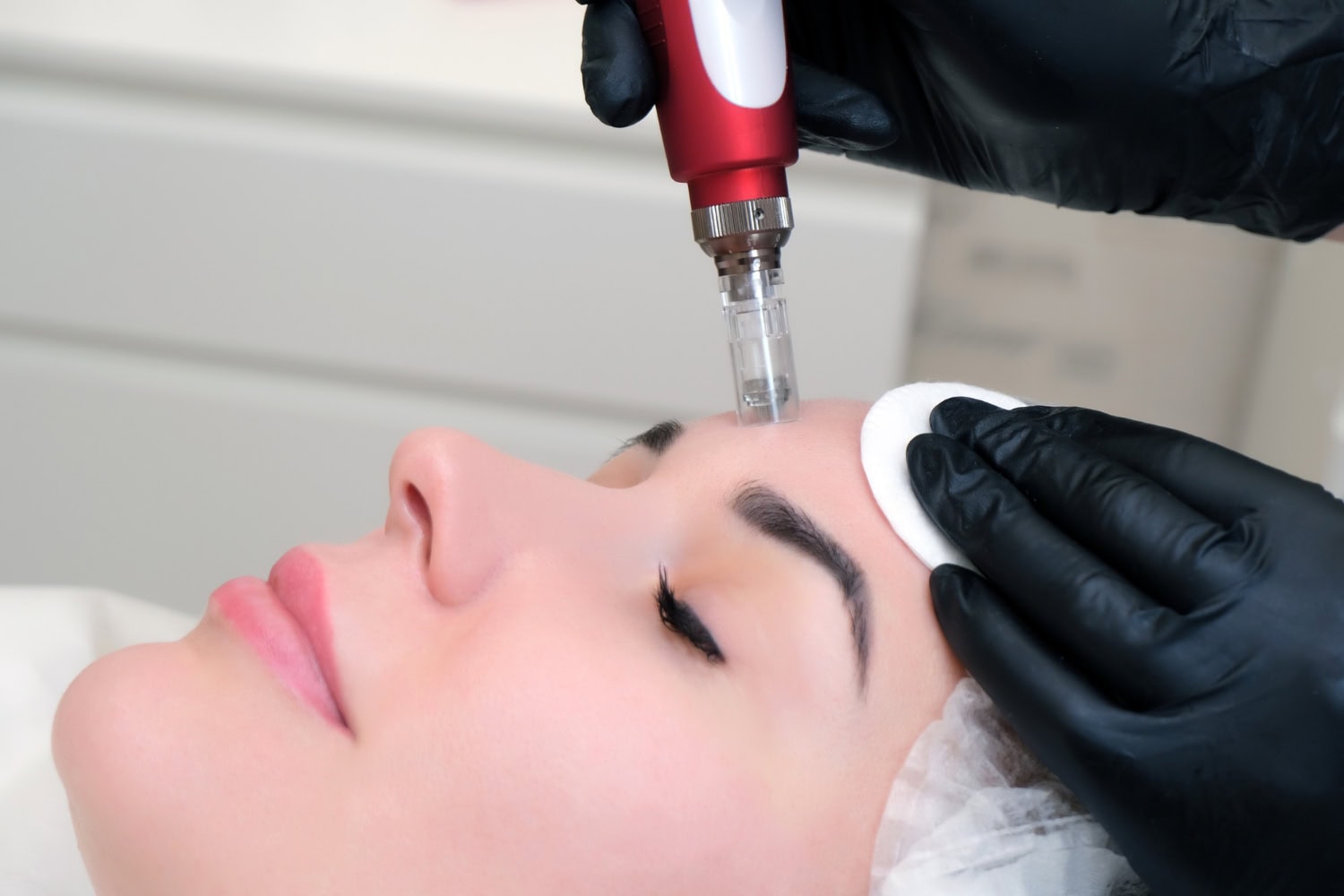 Microneedling