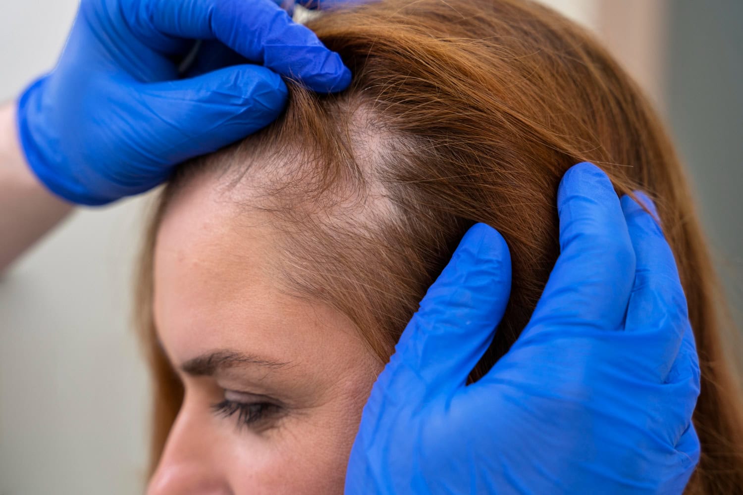 laser hair regrowth